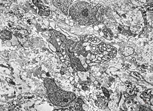 F,12y. | malignant tumor of the orbita - liposarcoma?, neurofibrosarcoma? F,12y. | malignant tumor of the orbita - liposarcoma?, neurofibrosarcoma?